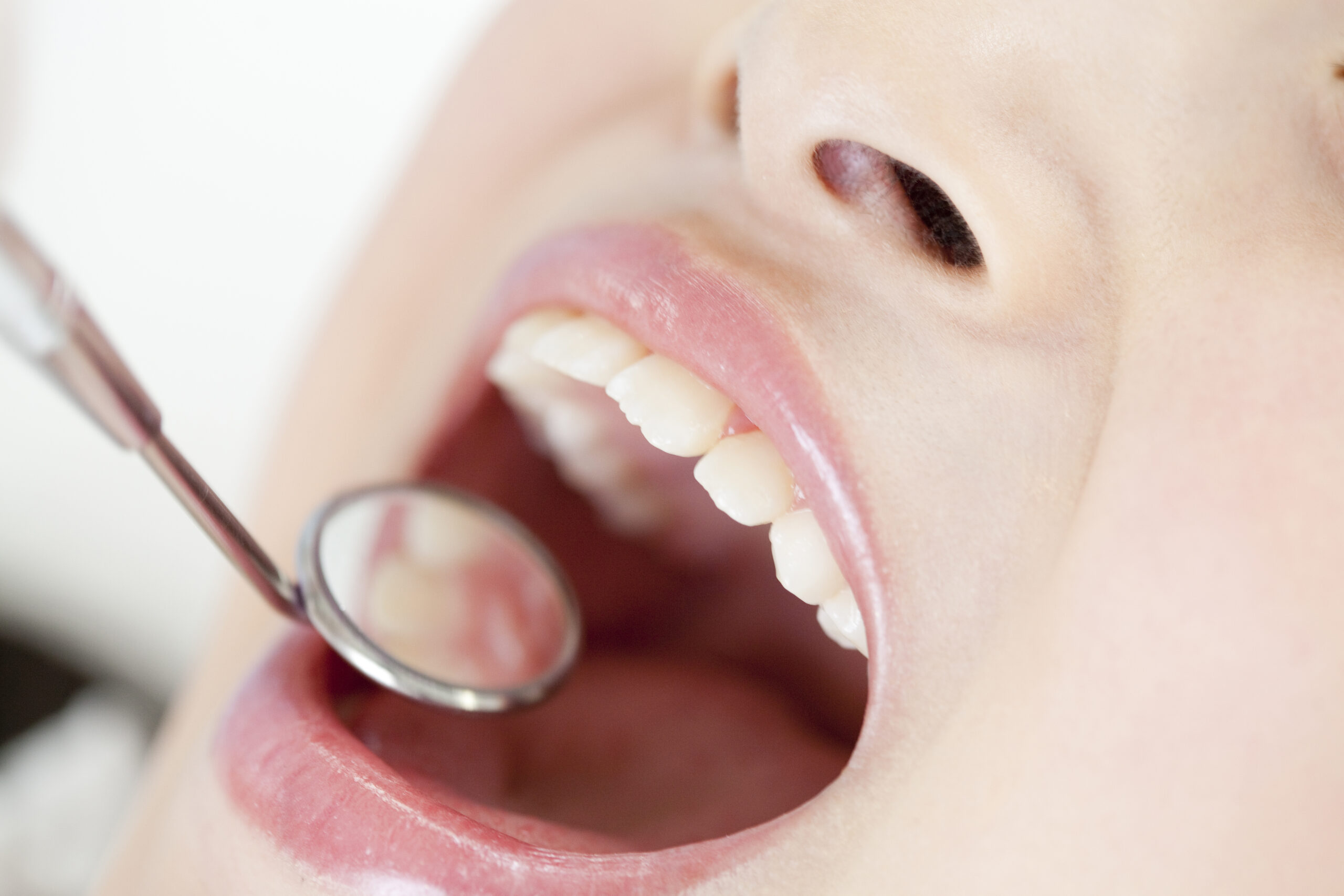 歯周病ってどんな病気？歯槽膿漏との違いや発症する原因を詳しく解説